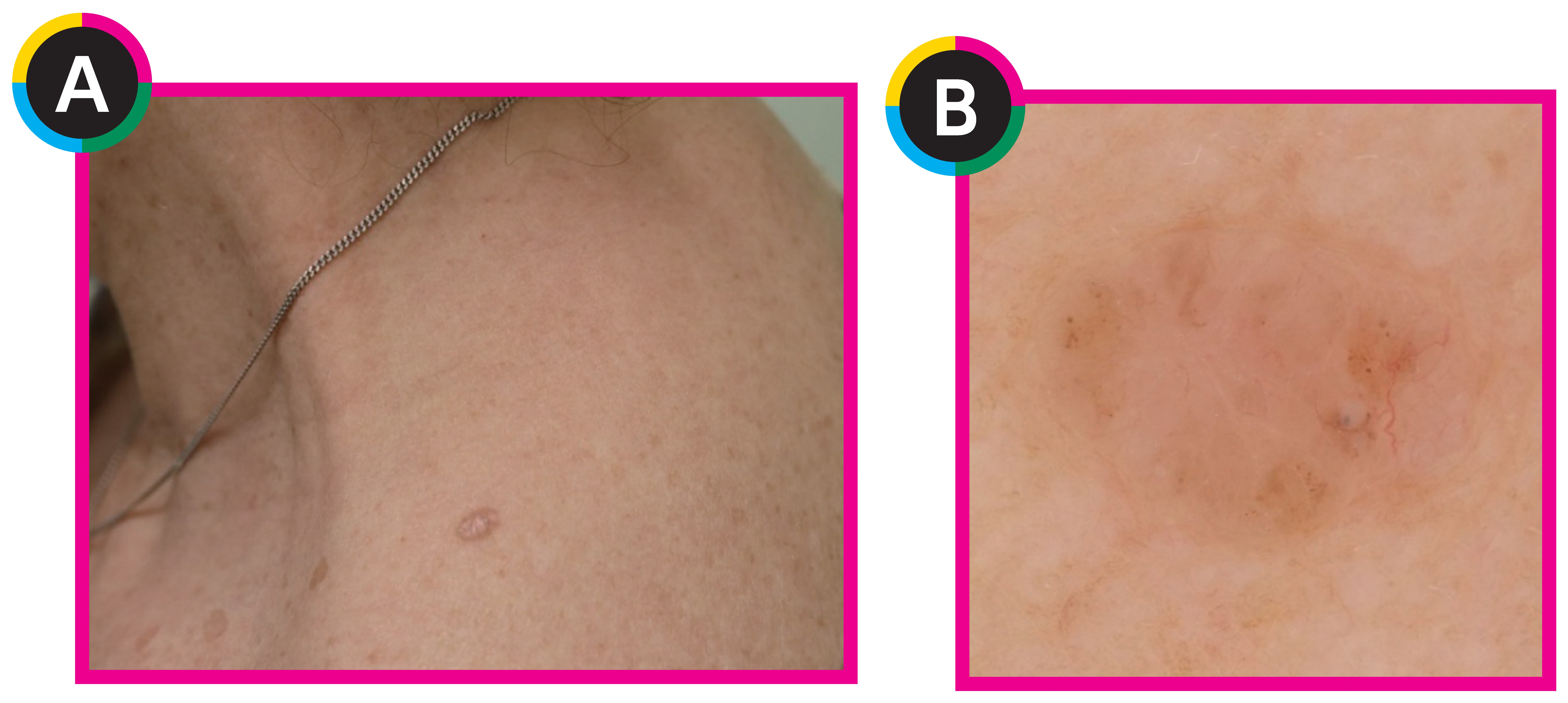 Visual Learning for Dermatology:基底細胞癌の診断 | Derma times