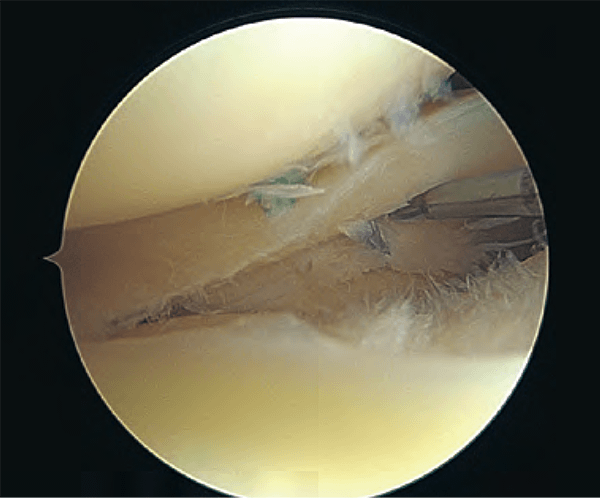 Ortho cutting edge:鏡視下半月板修復術（縫合術）の各種方法と