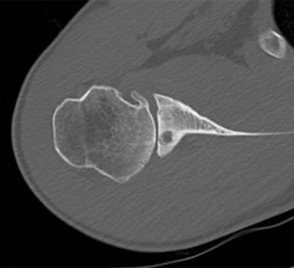 Ortho cutting edge:アナトミカル型人工肩関節の手術技法 | ORTHO