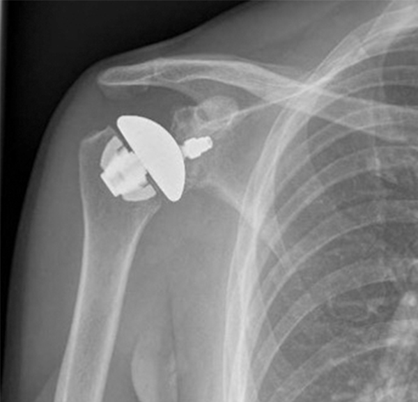 Ortho cutting edge:アナトミカル型人工肩関節の手術技法 | ORTHO