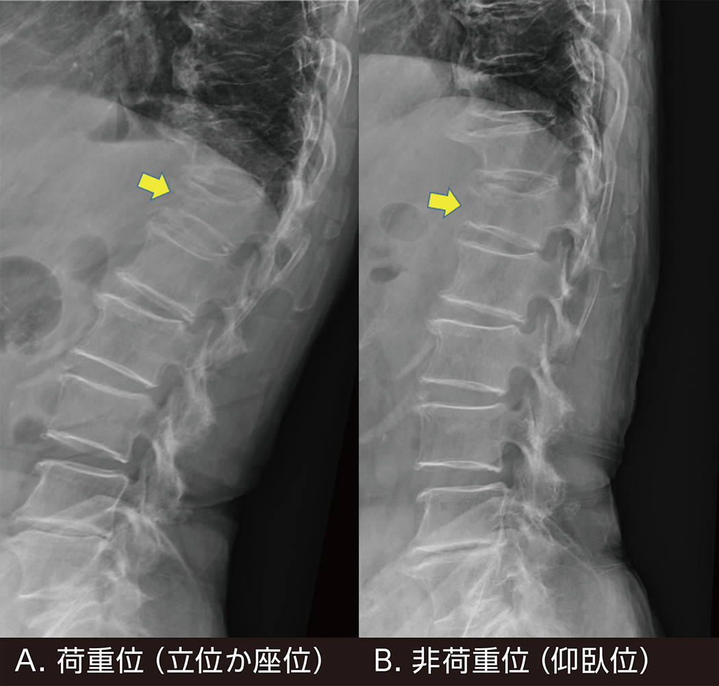 ORTHO DIAGNOSTIC Imaging:新鮮骨粗鬆症性椎体骨折の画像診断の