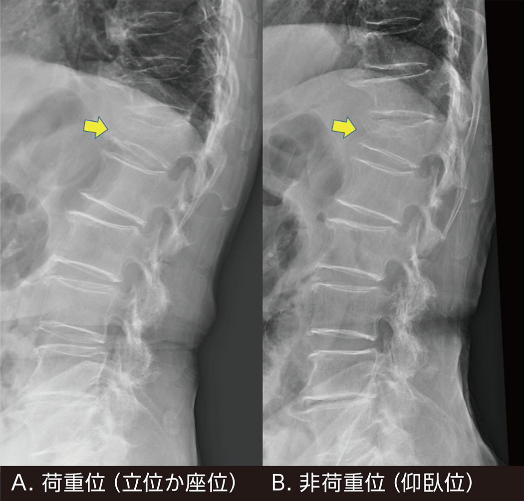 ORTHO DIAGNOSTIC Imaging:新鮮骨粗鬆症性椎体骨折の画像診断の