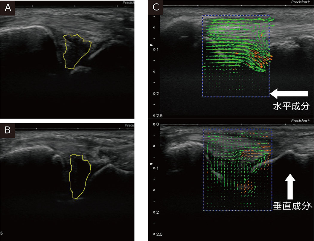 ORTHO DIAGNOSTIC Imaging:エコーとAIで診断するTFCC損傷 | ORTHO