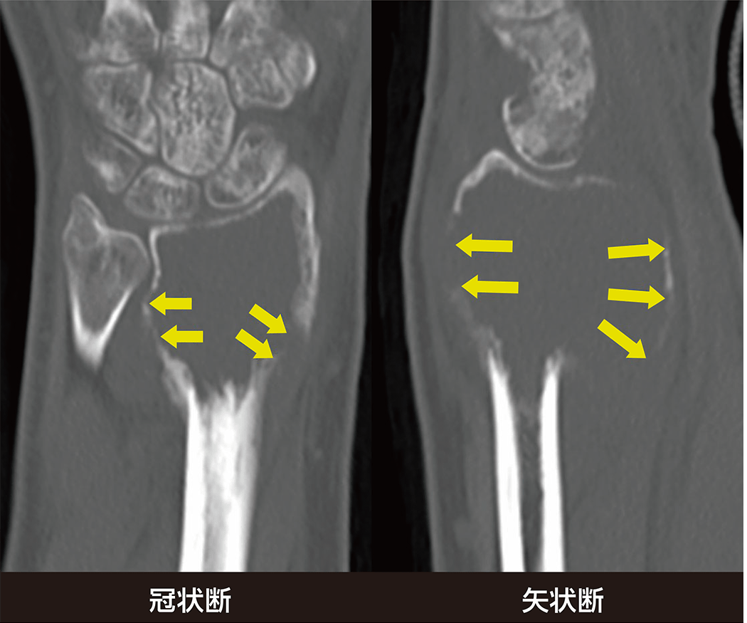 骨巨細胞腫とは : 病理標本:骨巨細胞腫|新潟大学医学部臨床病理学分野 – ALDWR