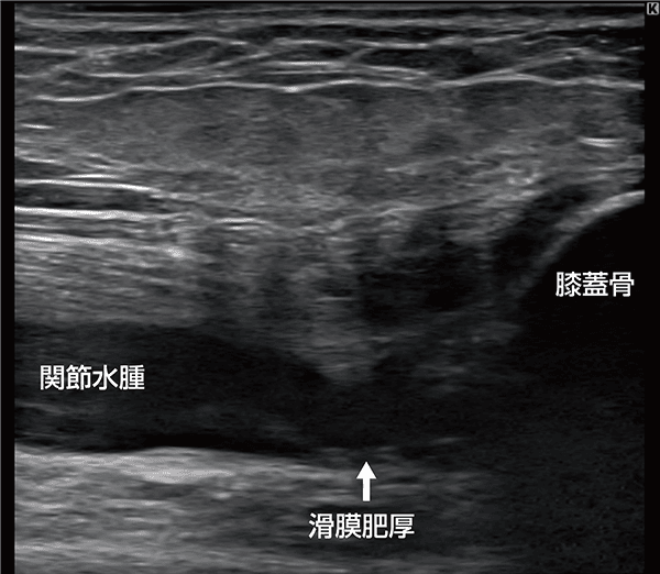 ORTHO DIAGNOSTIC Imaging:早期変形性膝関節症の超音波分類 ―KENROKU 8
