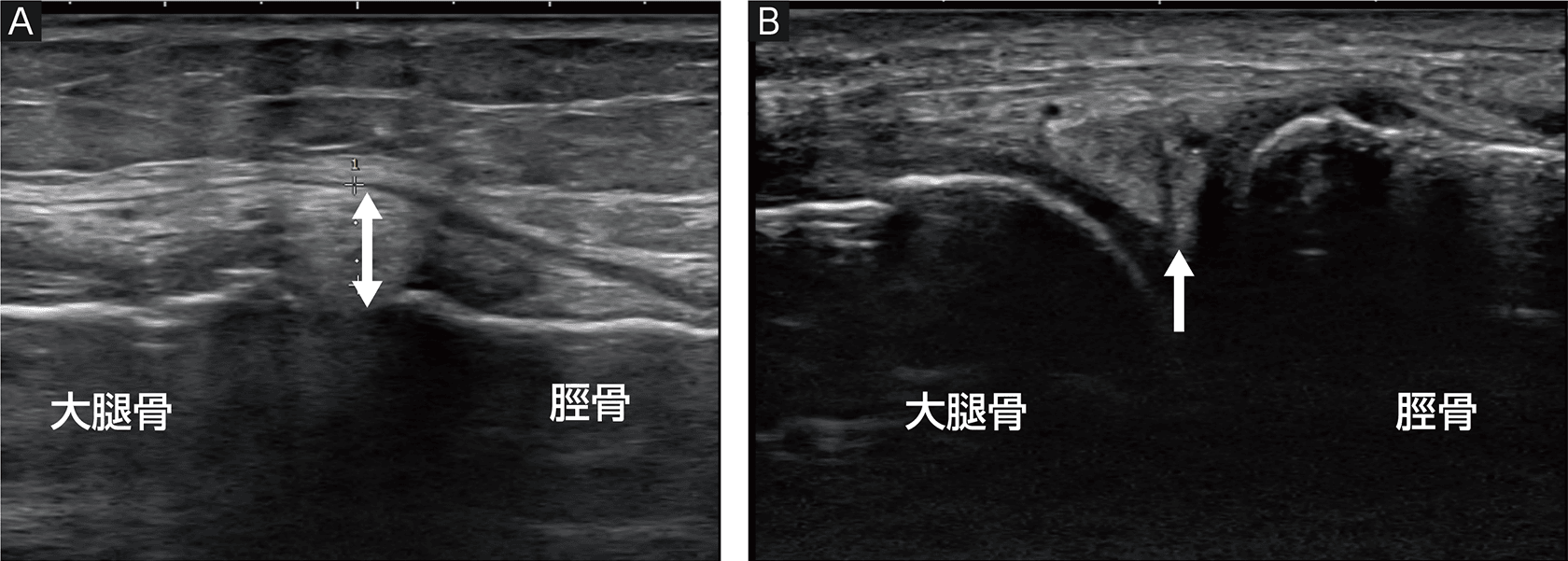 ORTHO DIAGNOSTIC Imaging:早期変形性膝関節症の超音波分類 ―KENROKU 8