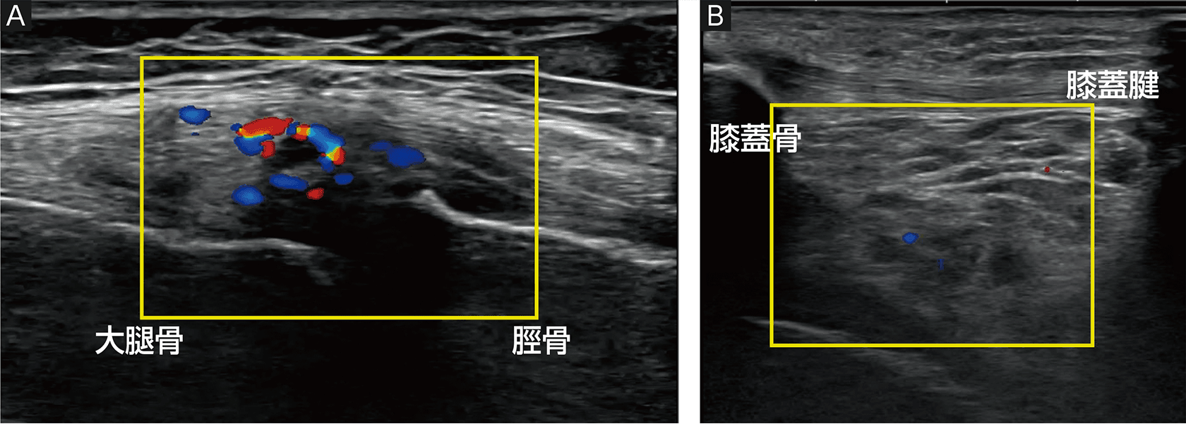 ORTHO DIAGNOSTIC Imaging:早期変形性膝関節症の超音波分類 ―KENROKU 8
