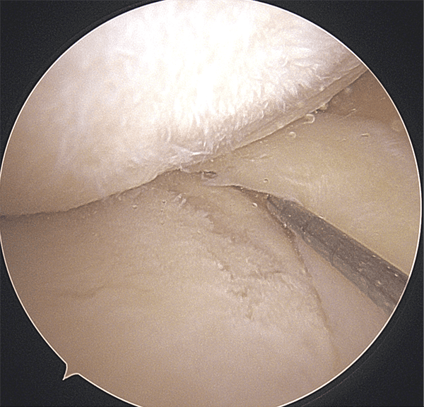 ORTHO DIAGNOSTIC Imaging:膝半月板後根断裂の診断 | ORTHO Times
