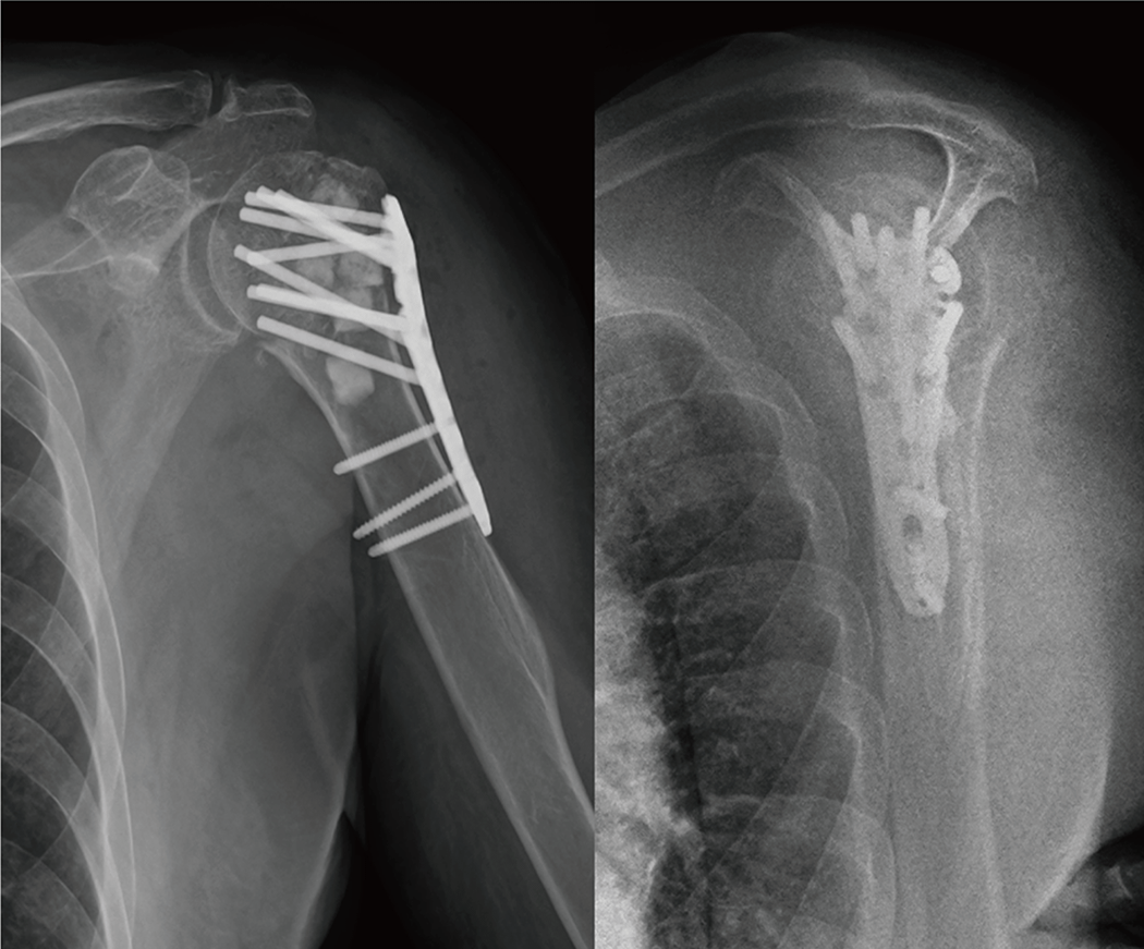 Questionnaire:上腕骨近位部骨折の治療選択 | ORTHO Times | 科研製薬