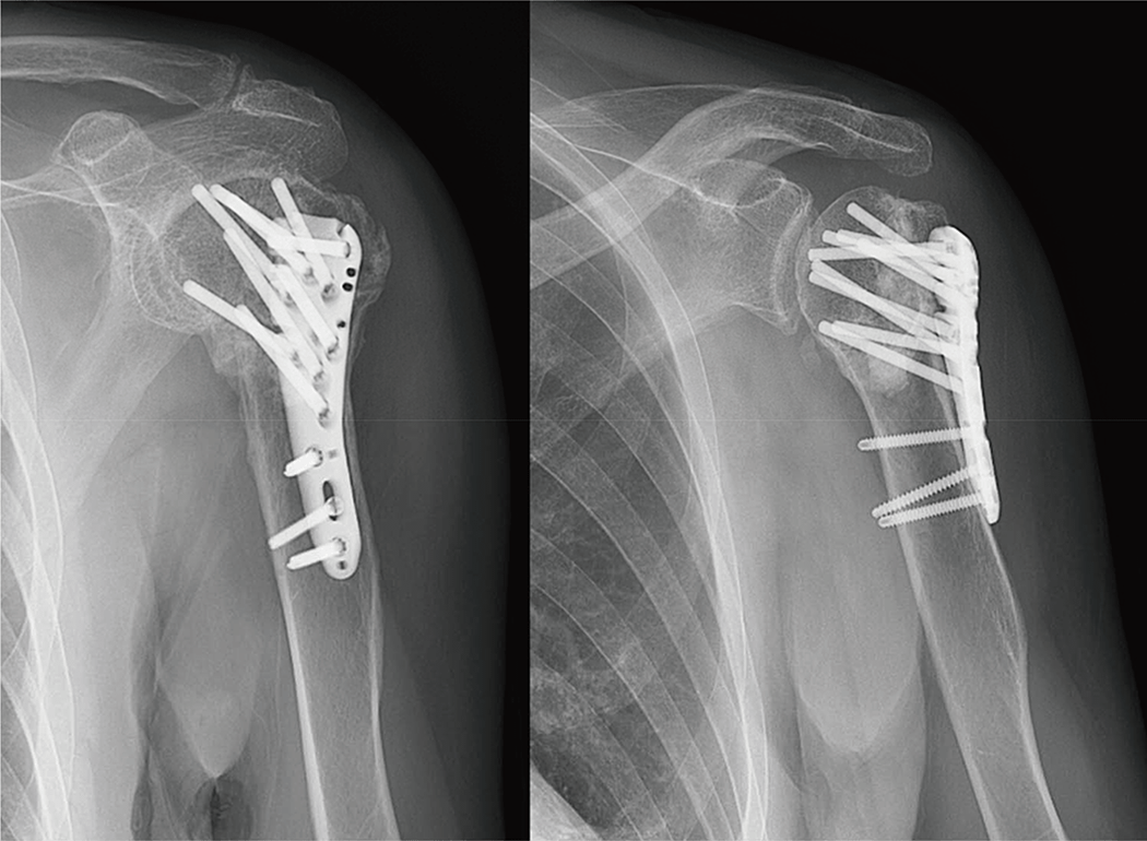Questionnaire:上腕骨近位部骨折の治療選択 | ORTHO Times | 科研製薬