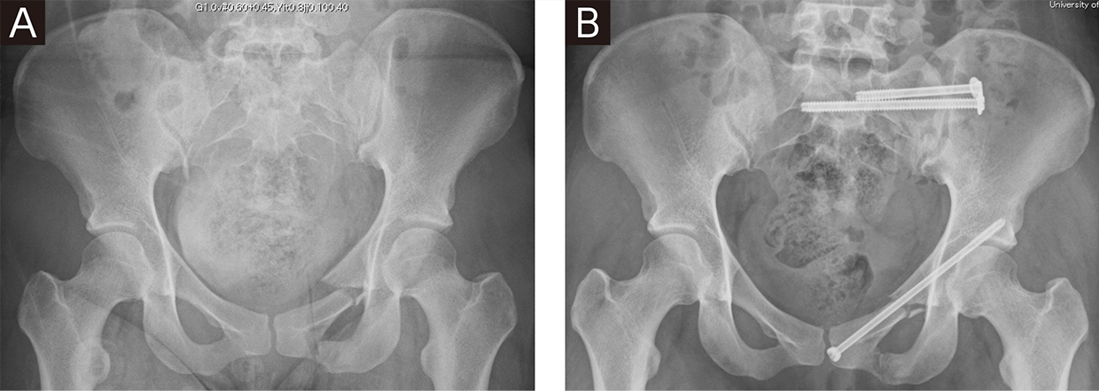 CHANEL 専用ページ 大腿骨頚部骨折SOAP ファシオール / 骨盤リフトシェイパー