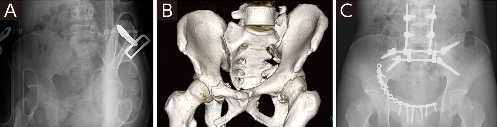 骨盤骨折　Surgical technique 骨盤骨折: 寛骨臼骨折・骨盤輪骨折の手術手技 (整形外科SURGICAL