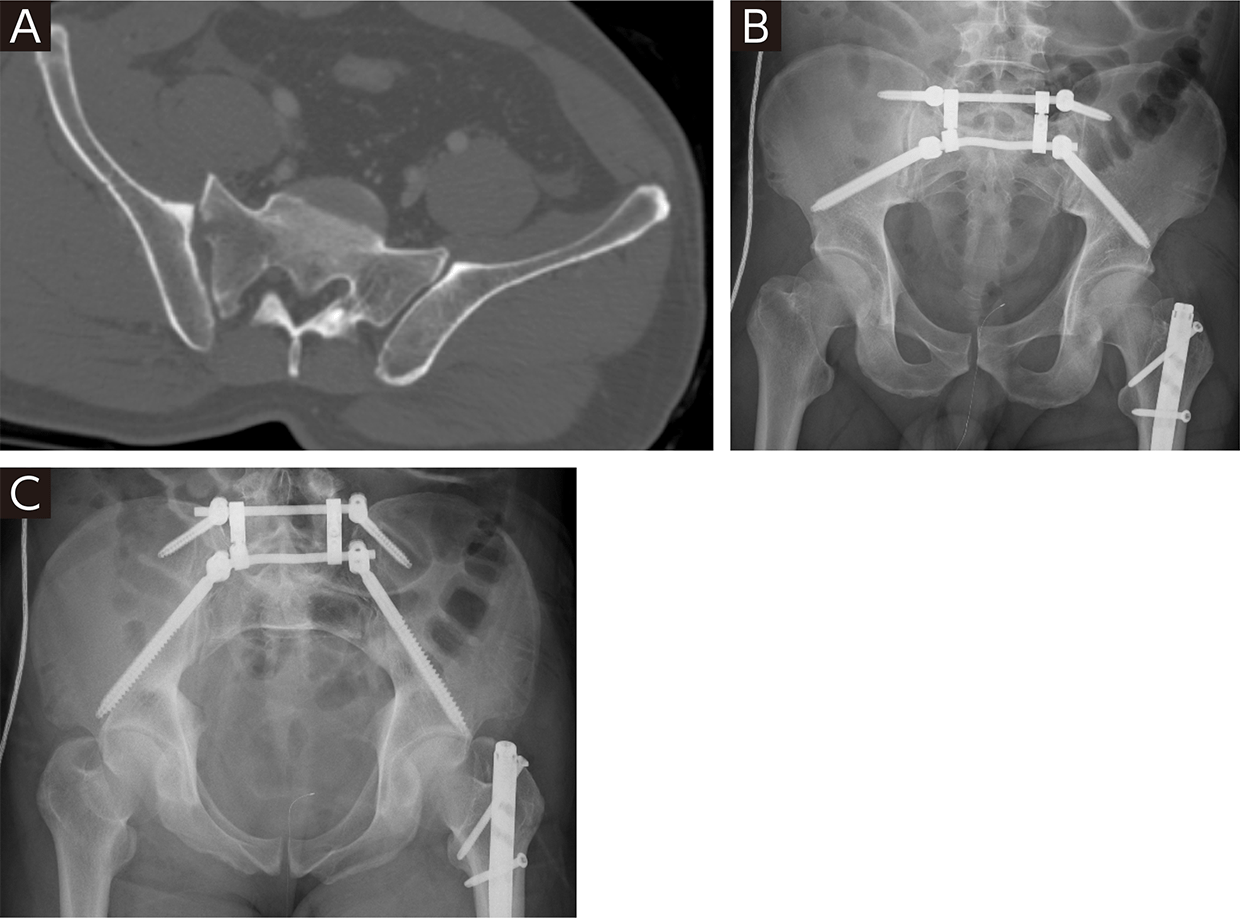 TECHNIQUE UP-TO-DATE:高エネルギー骨盤輪損傷の手術 | ORTHO