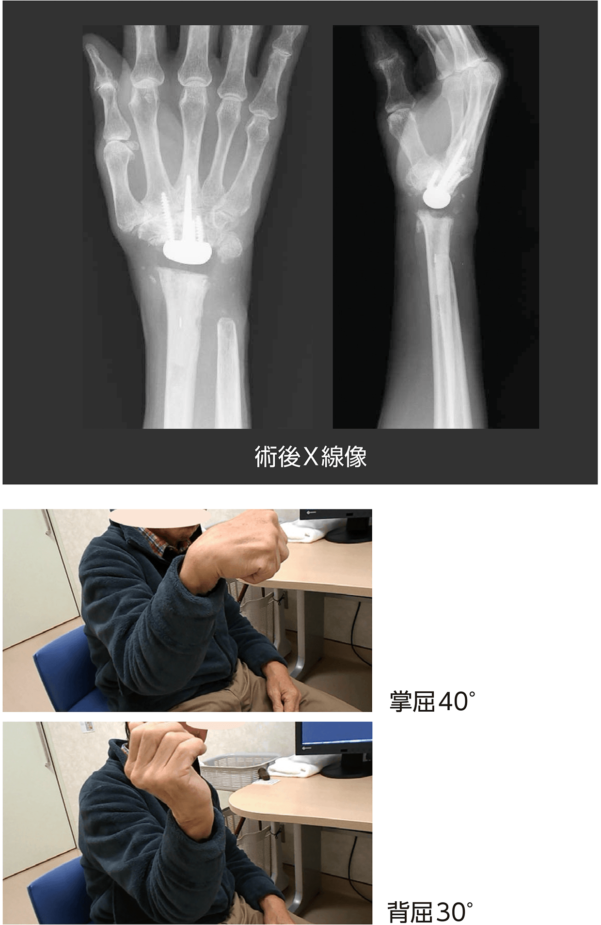 TECHNIQUE UP-TO-DATE:人工手関節全置換術の手術手技とその治療成績